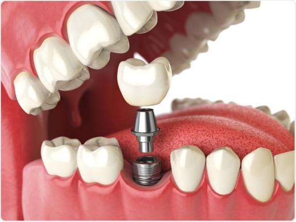 Les implants dentaires : un acte médical exonéré de Taxe sur la Valeur Ajoutée (TVA)